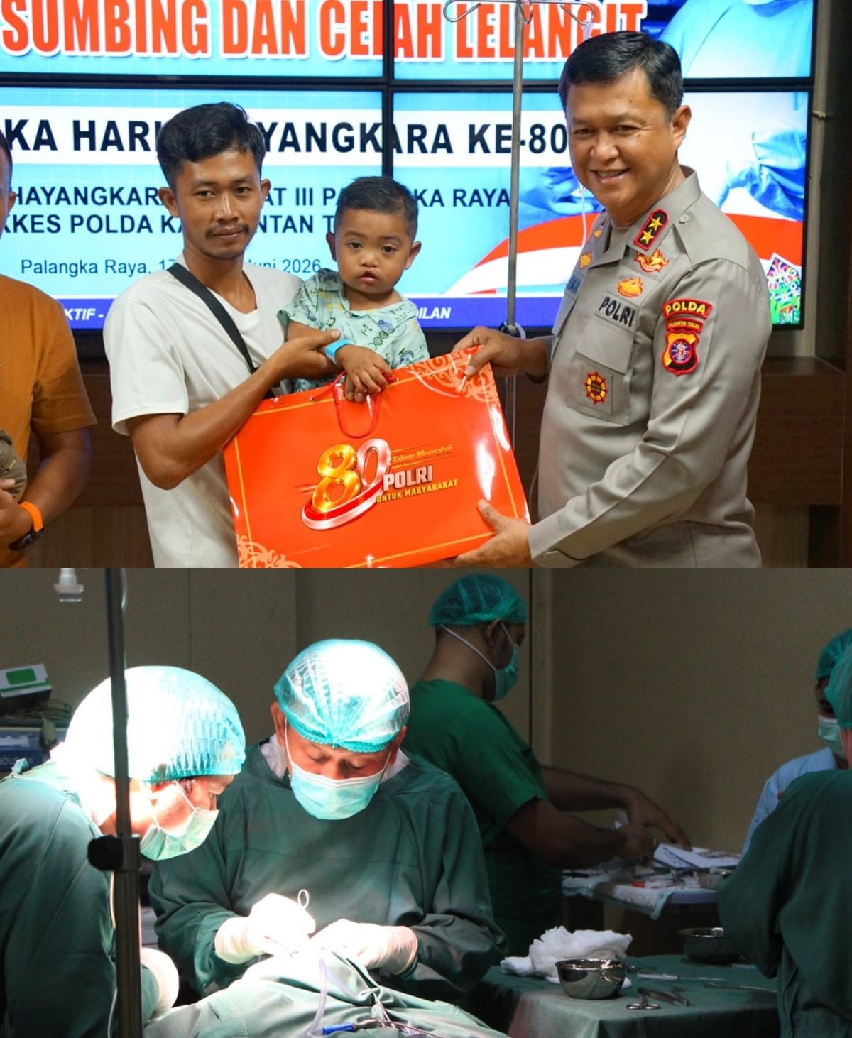 Polda Kalteng Gelar operasi Bibir Sumbing di Hari Bhayangkara ke-80